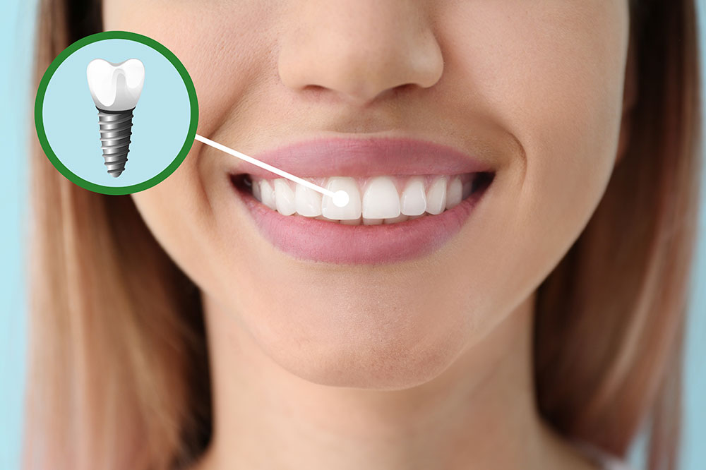 Dental Implants – Its Types and Associated Costs