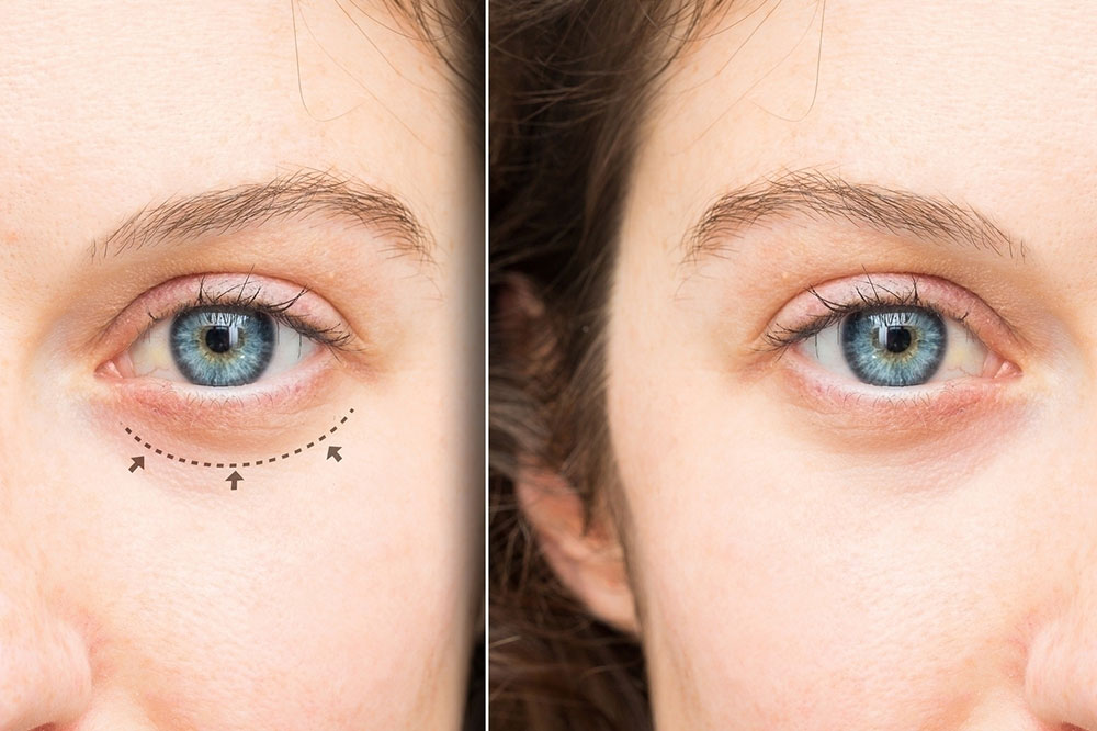 Everything to Know about Eye Bag Surgeries