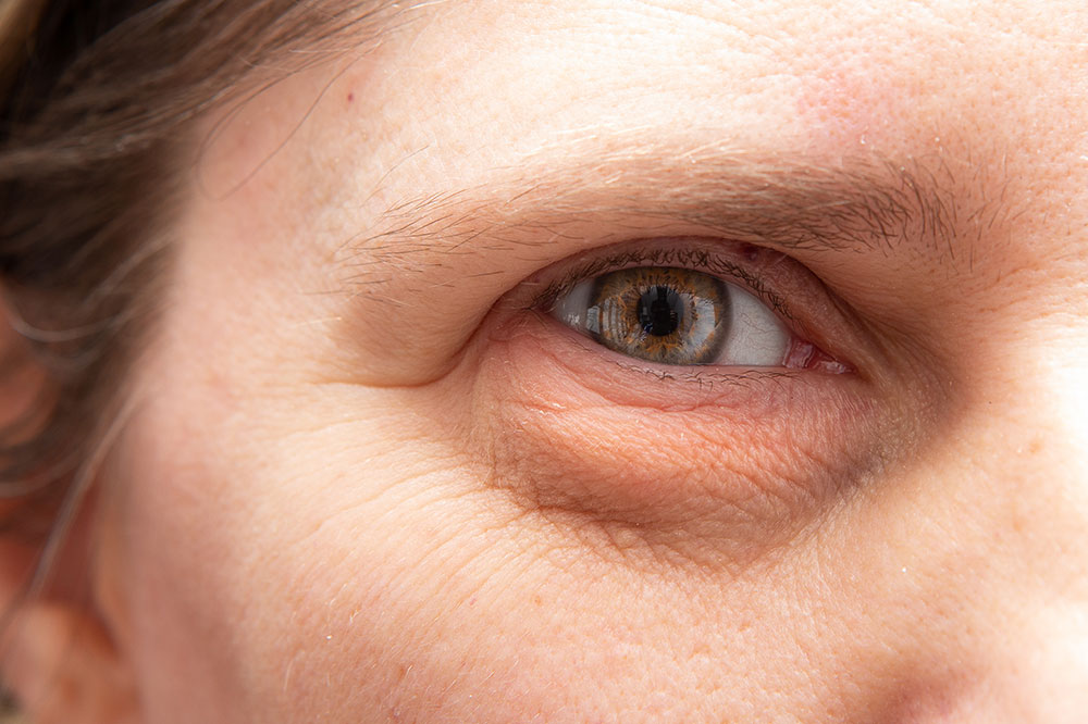 Eye Bag Removal Procedures for Seniors – Things to Keep in Mind